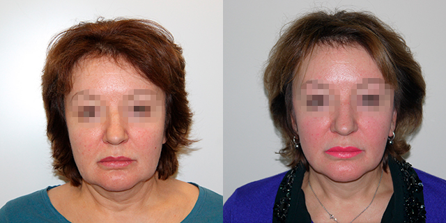 facelifting-results_05