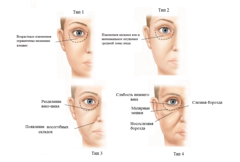 Зона глаз. Периорбитальная зона анатомия. Периорбитальная зона (верхнее и нижнее веко). Возрастные изменения периорбитальной зоны. Периорбитальная область вокруг глаз.