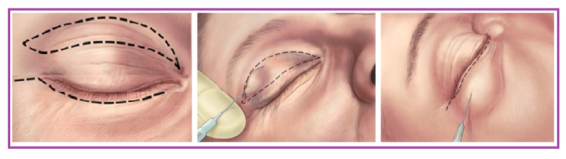 Разметка и введение анестетика при лифтинге средней зоны лица